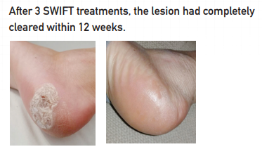 WART THERAPY 3 DAP Swift Testimonial3